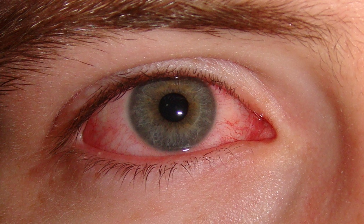 Bloodshot Eyes: What to Do, When to Worry