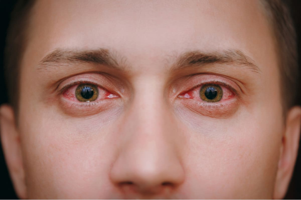 Bloodshot Eyes: What to Do, When to Worry